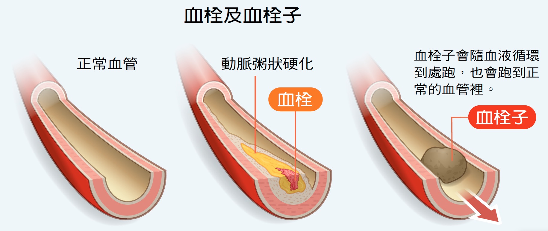 哪種人會有血栓